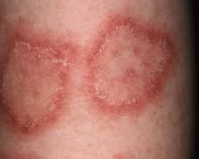 Skin Disorders Treatment — BrahmaMadhurya Homoeopathy Clinic