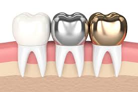 Dental Crowns — Dentist4u