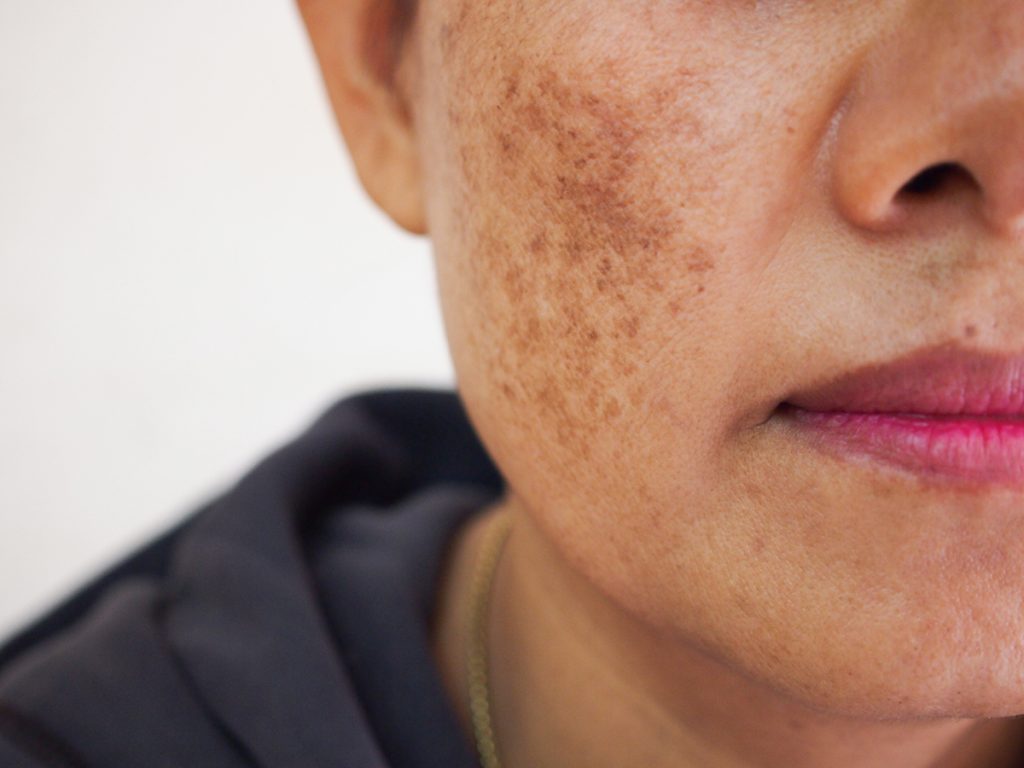 Skin & Pigmentation