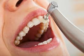 Teeth Cleaning — Dentist4u