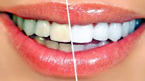 Teeth Whitening — Dentist4u