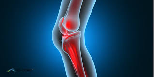 Knee Pain — Metro phoenix hospital