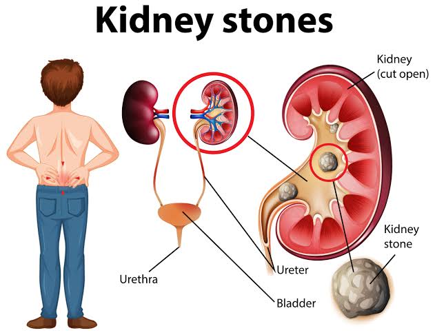 Kidney Stone Treatment (मुतखडा उपचार) — Ayuraa Healthcare